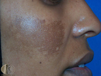 Melasma 1